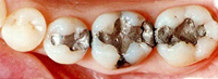銀歯の落とし穴
